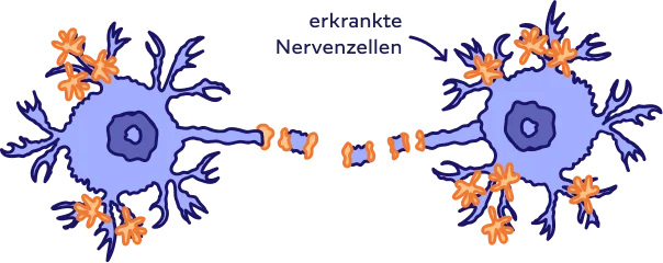 Zwei erkrankte Nervenzellen und deren gestörte Verbindung.