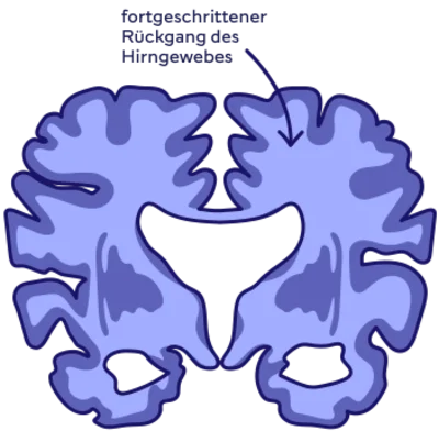 fortgeschrittene Alzheimer-Krankheit