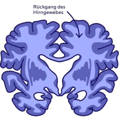 beginnende Alzheimer-Krankheit