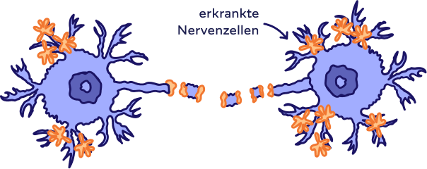 Zwei erkrankte Nervenzellen und deren gestörte Verbindung. 
